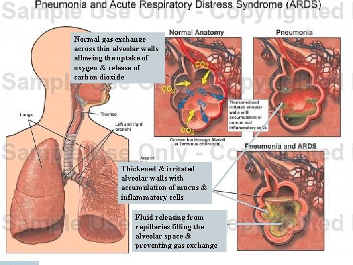 Normal gas exchange across thin alveolar walls allowing the uptake of oxygen & release