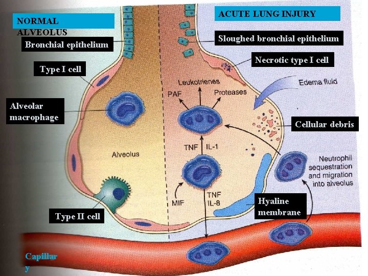 NORMAL ALVEOLUS Bronchial epithelium Type I cell Alveolar macrophage Type II cell Capillar y
