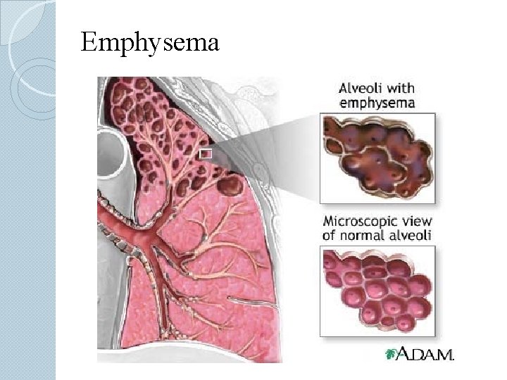 Emphysema 