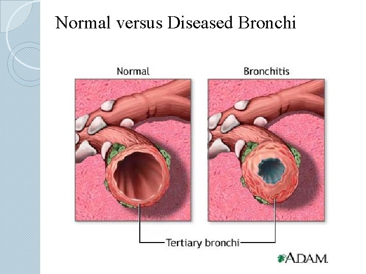Normal versus Diseased Bronchi 