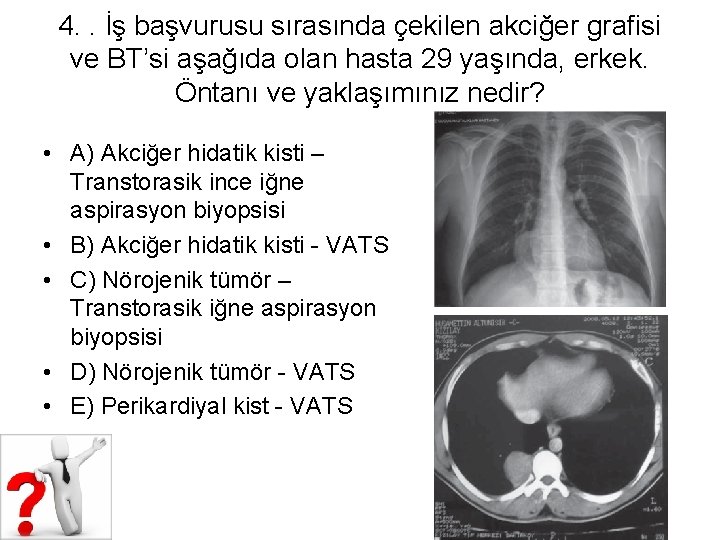 4. . İş başvurusu sırasında çekilen akciğer grafisi ve BT’si aşağıda olan hasta 29