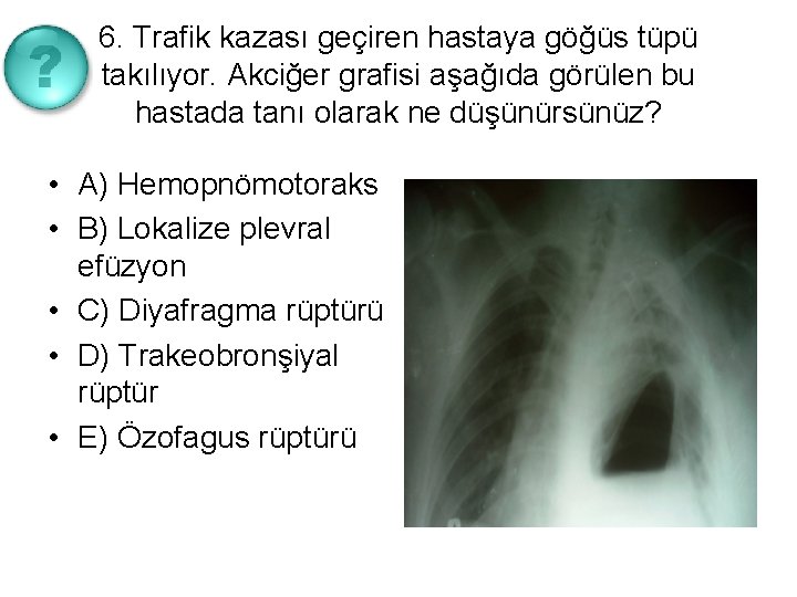 6. Trafik kazası geçiren hastaya göğüs tüpü takılıyor. Akciğer grafisi aşağıda görülen bu hastada