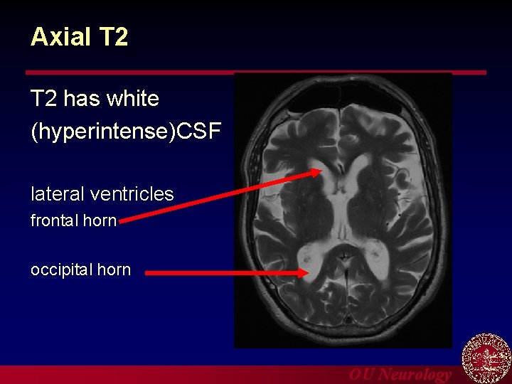 Axial T 2 has white (hyperintense)CSF lateral ventricles frontal horn occipital horn OU Neurology