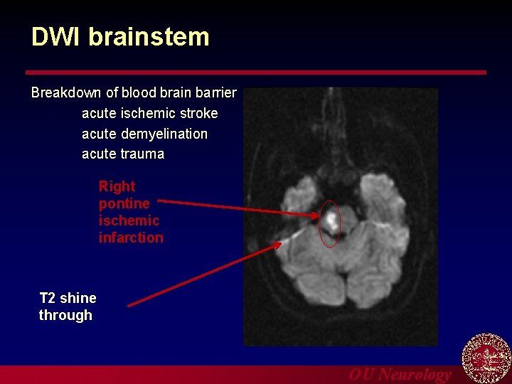 DWI brainstem Breakdown of blood brain barrier acute ischemic stroke acute demyelination acute trauma