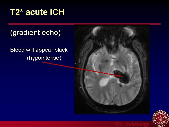 T 2* acute ICH (gradient echo) Blood will appear black (hypointense) OU Neurology 