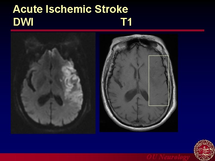 Acute Ischemic Stroke DWI T 1 OU Neurology 