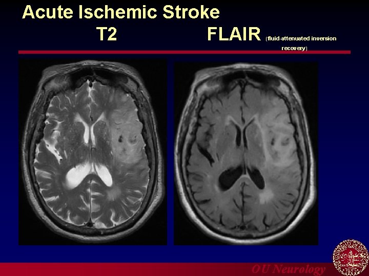 Acute Ischemic Stroke T 2 FLAIR (fluid-attenuated inversion recovery) OU Neurology 