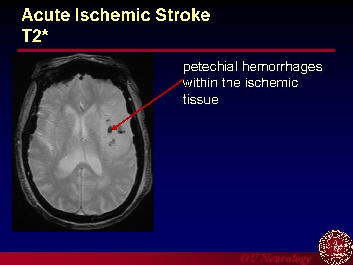 Acute Ischemic Stroke T 2* petechial hemorrhages within the ischemic tissue OU Neurology 