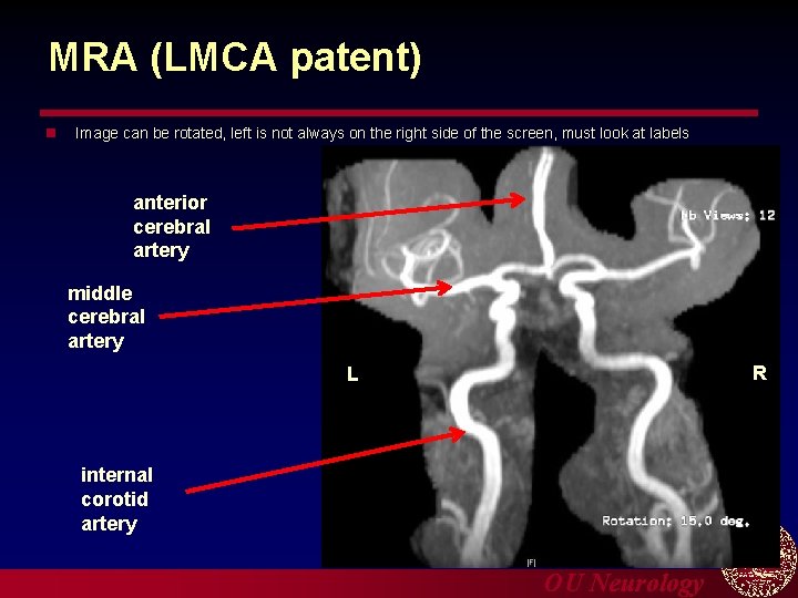 MRA (LMCA patent) n Image can be rotated, left is not always on the