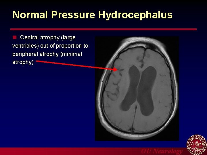 Normal Pressure Hydrocephalus n Central atrophy (large ventricles) out of proportion to peripheral atrophy