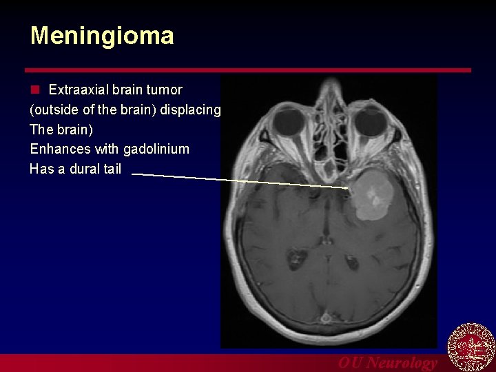 Meningioma n Extraaxial brain tumor (outside of the brain) displacing The brain) Enhances with