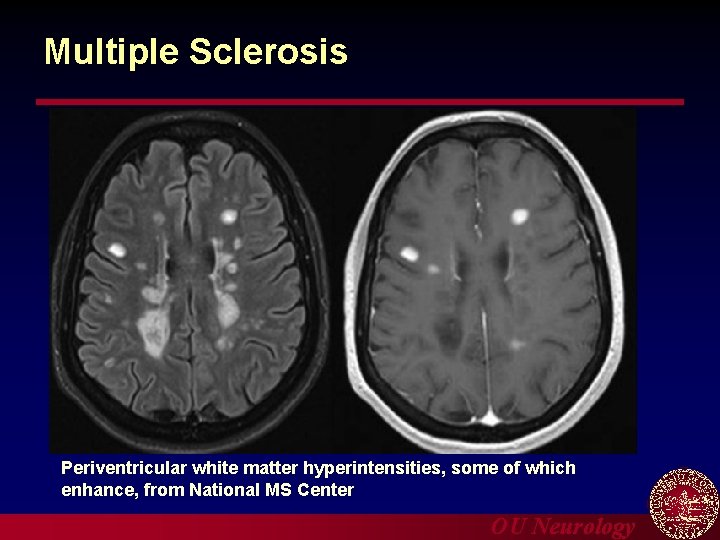 Multiple Sclerosis Periventricular white matter hyperintensities, some of which enhance, from National MS Center