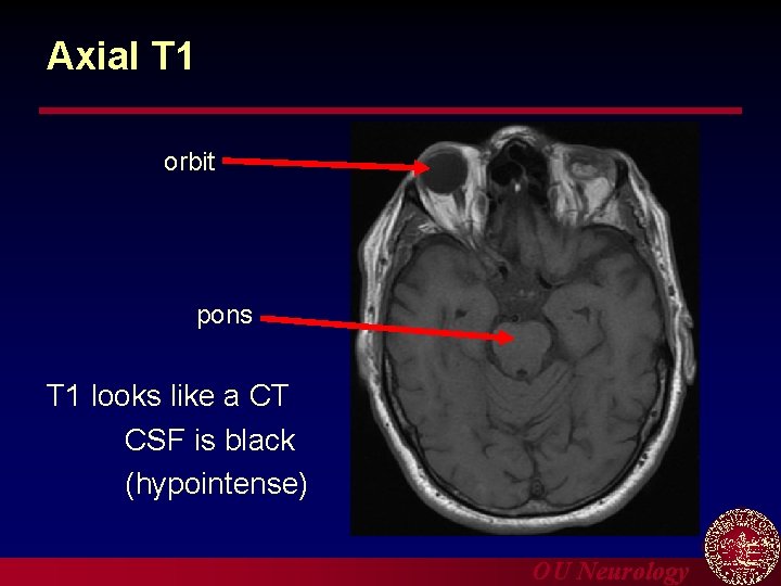 Axial T 1 orbit pons T 1 looks like a CT CSF is black