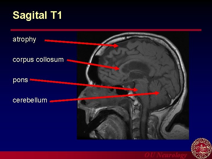Sagital T 1 atrophy corpus collosum pons cerebellum OU Neurology 