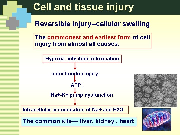 Cell and tissue injury Reversible injury--cellular swelling The commonest and earliest form of cell