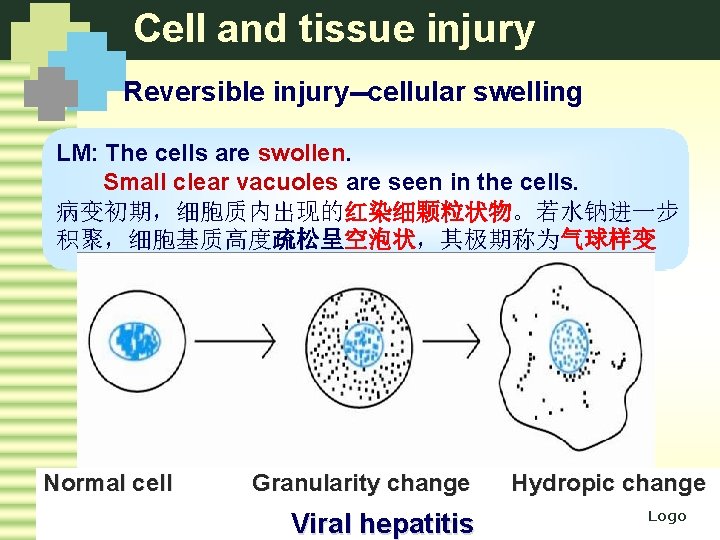 Cell and tissue injury Reversible injury--cellular swelling LM: The cells are swollen. Small clear