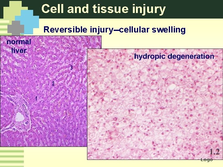 Cell and tissue injury Reversible injury--cellular swelling Logo 