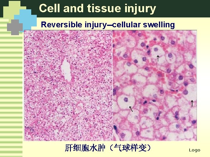 Cell and tissue injury Reversible injury--cellular swelling 肝细胞水肿（气球样变） Logo 