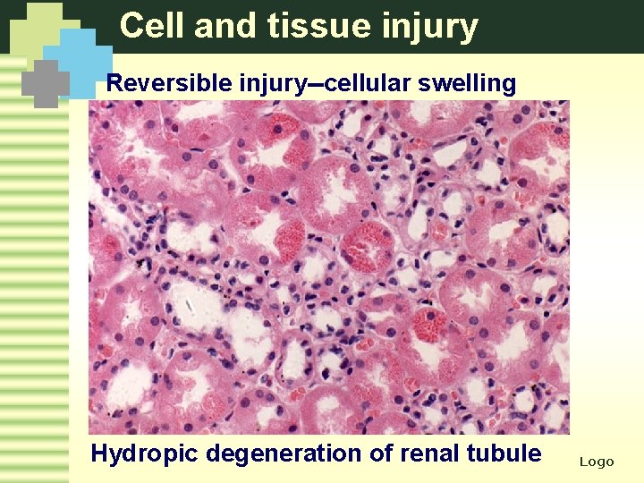 Cell and tissue injury Reversible injury--cellular swelling Hydropic degeneration of renal tubule Logo 