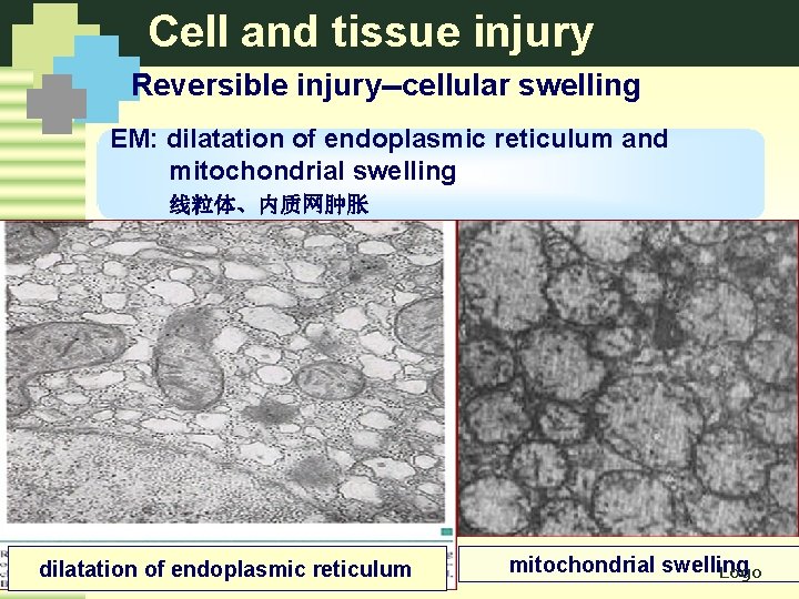 Cell and tissue injury Reversible injury--cellular swelling EM: dilatation of endoplasmic reticulum and mitochondrial