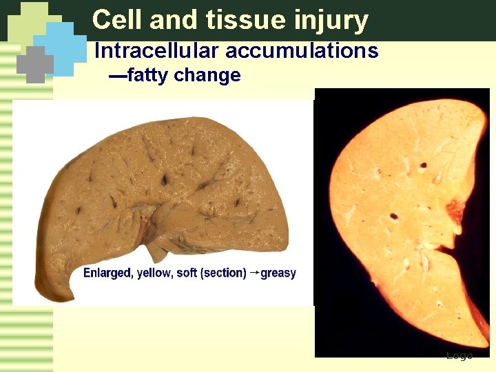 Cell and tissue injury Intracellular accumulations ---fatty change Logo 