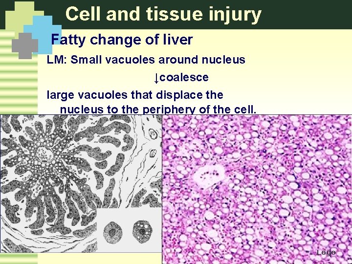 Cell and tissue injury Fatty change of liver LM: Small vacuoles around nucleus ↓coalesce