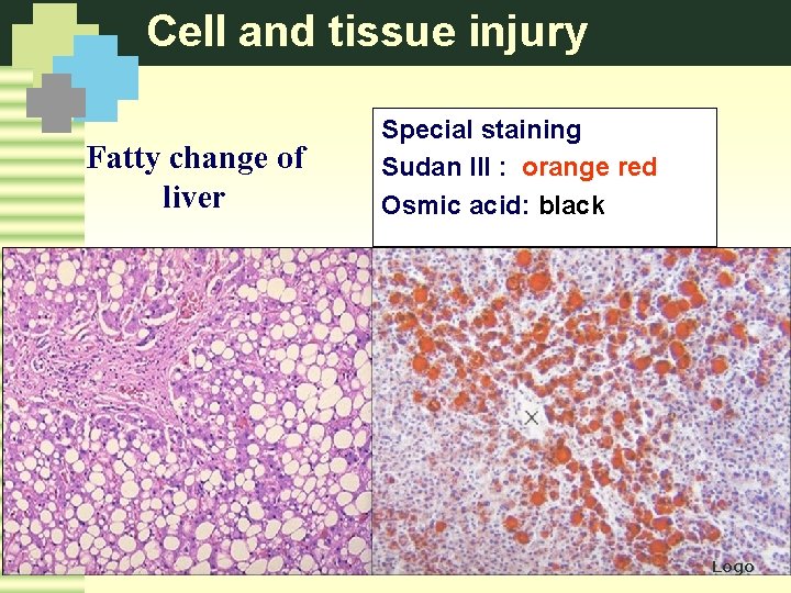 Cell and tissue injury Fatty change of liver Special staining Sudan III : orange