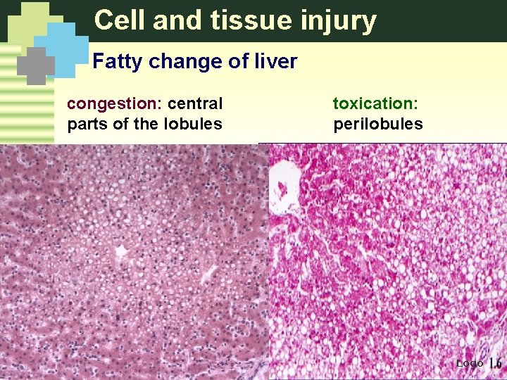 Cell and tissue injury Fatty change of liver congestion: central parts of the lobules