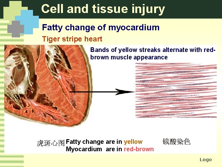 Cell and tissue injury Fatty change of myocardium Tiger stripe heart Bands of yellow