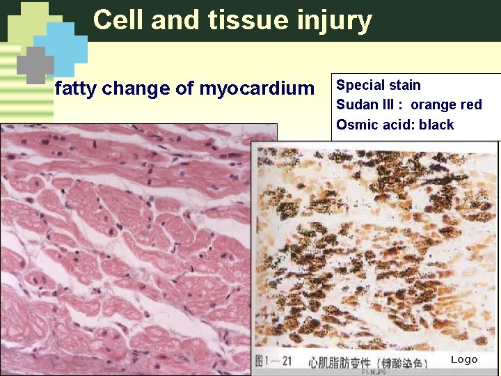 Cell and tissue injury fatty change of myocardium Special stain Sudan III : orange