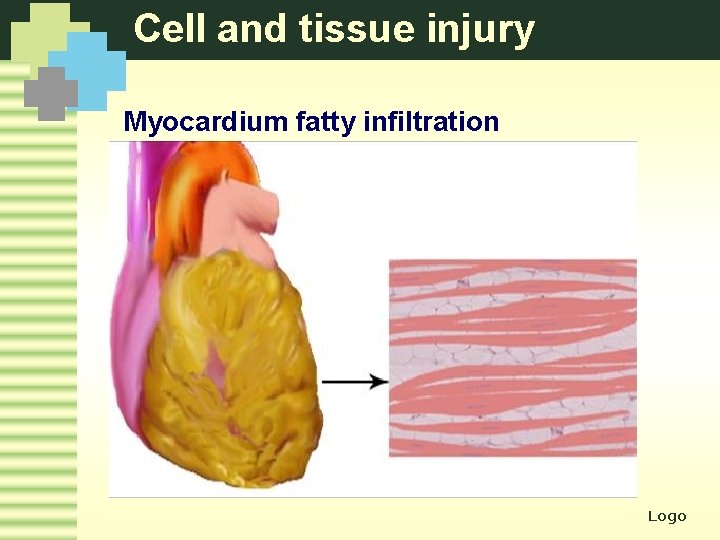 Cell and tissue injury Myocardium fatty infiltration Logo 