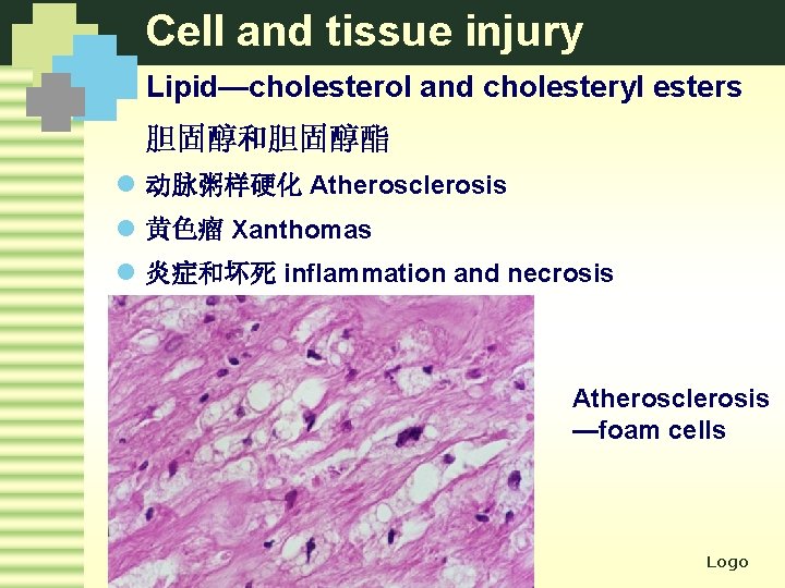 Cell and tissue injury Lipid—cholesterol and cholesteryl esters 胆固醇和胆固醇酯 l 动脉粥样硬化 Atherosclerosis l 黄色瘤