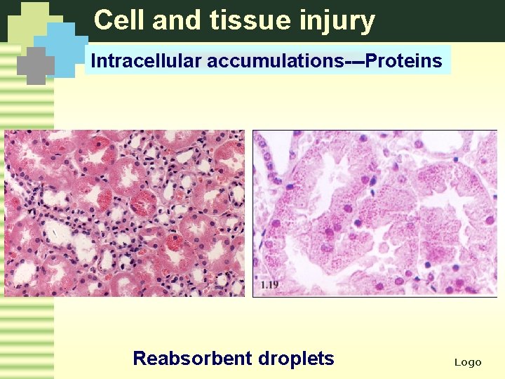 Cell and tissue injury Intracellular accumulations---Proteins Reabsorbent droplets Logo 