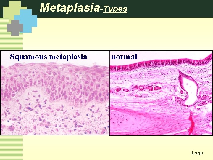 Metaplasia-Types Squamous metaplasia normal Logo 