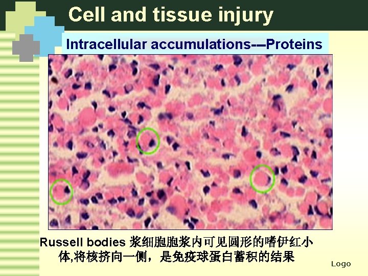 Cell and tissue injury Intracellular accumulations---Proteins Russell bodies 浆细胞胞浆内可见圆形的嗜伊红小 体, 将核挤向一侧，是免疫球蛋白蓄积的结果 Logo 