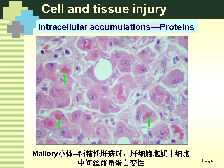 Cell and tissue injury Intracellular accumulations---Proteins Mallory小体--酒精性肝病时，肝细胞胞质中细胞 中间丝前角蛋白变性 Logo 