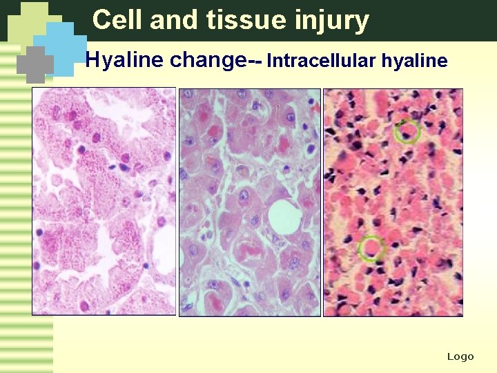 Cell and tissue injury Hyaline change-- Intracellular hyaline Logo 