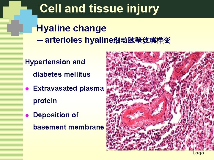 Cell and tissue injury Hyaline change -- arterioles hyaline细动脉壁玻璃样变 Hypertension and diabetes mellitus l