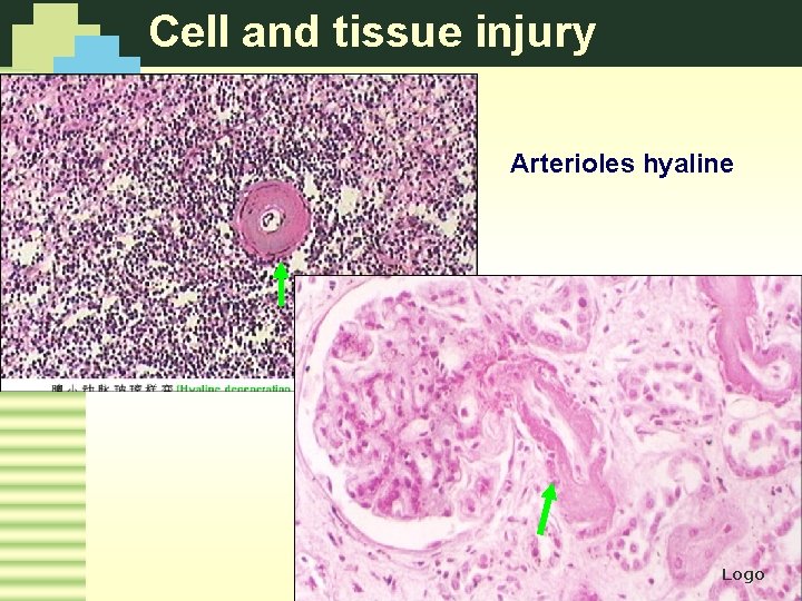 Cell and tissue injury Arterioles hyaline Logo 