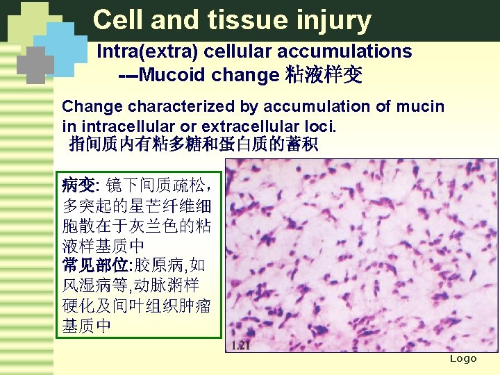 Cell and tissue injury Intra(extra) cellular accumulations ---Mucoid change 粘液样变 Change characterized by accumulation