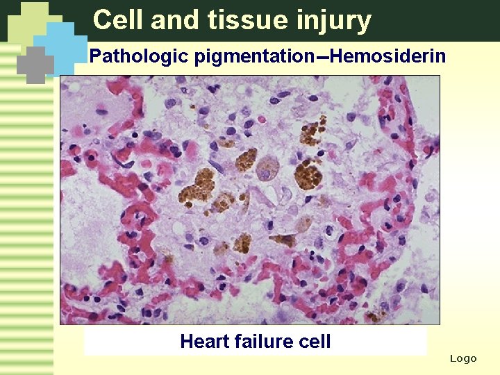 Cell and tissue injury Pathologic pigmentation--Hemosiderin Heart failure cell Logo 