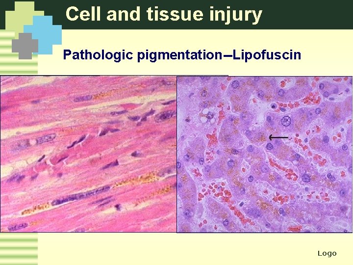 Cell and tissue injury Pathologic pigmentation--Lipofuscin Logo 