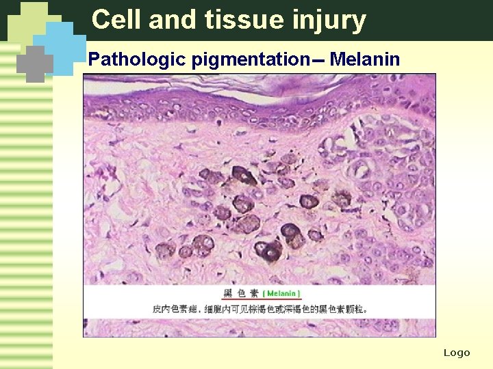 Cell and tissue injury Pathologic pigmentation-- Melanin Logo 