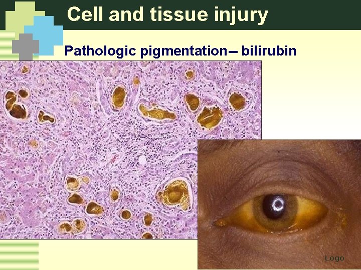 Cell and tissue injury Pathologic pigmentation-- bilirubin Logo 