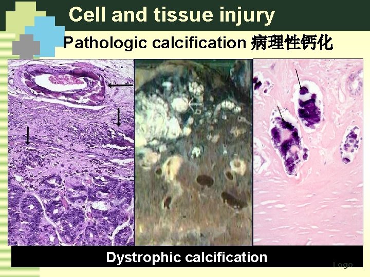 Cell and tissue injury Pathologic calcification 病理性钙化 Dystrophic calcification Logo 