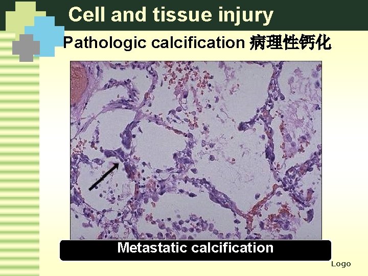 Cell and tissue injury Pathologic calcification 病理性钙化 Metastatic calcification Logo 