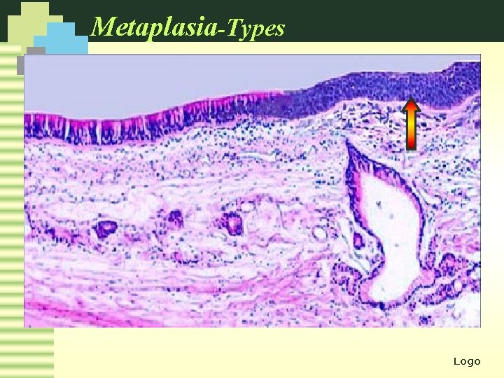 Metaplasia-Types Squamous metaplasia Logo 