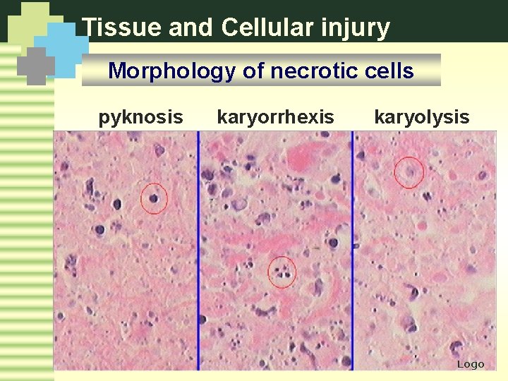 Tissue and Cellular injury Morphology of necrotic cells pyknosis karyorrhexis karyolysis Logo 