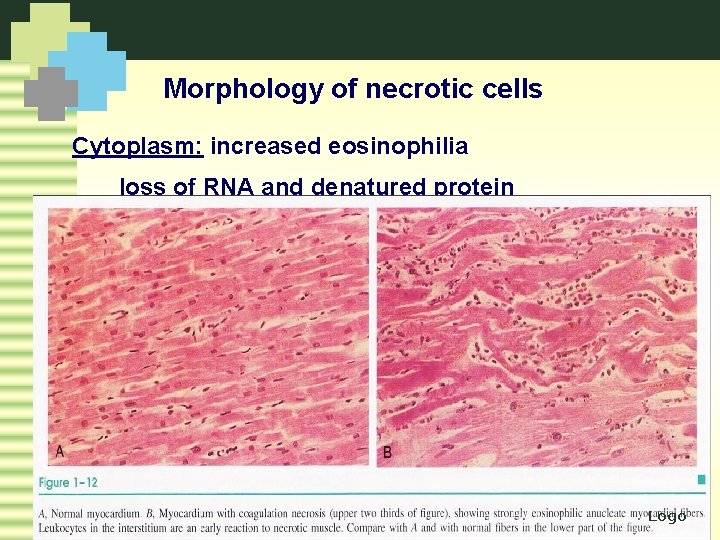 Morphology of necrotic cells Cytoplasm: increased eosinophilia loss of RNA and denatured protein Logo