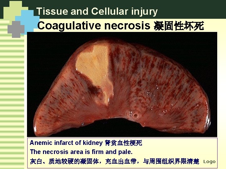 Tissue and Cellular injury Coagulative necrosis 凝固性坏死 Anemic infarct of kidney 肾贫血性梗死 The necrosis